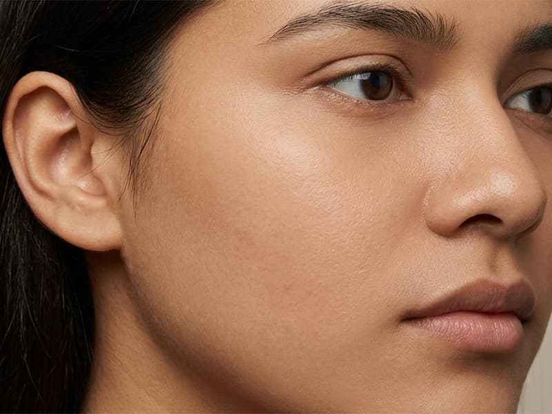 After — clear, radiant skin after treatment