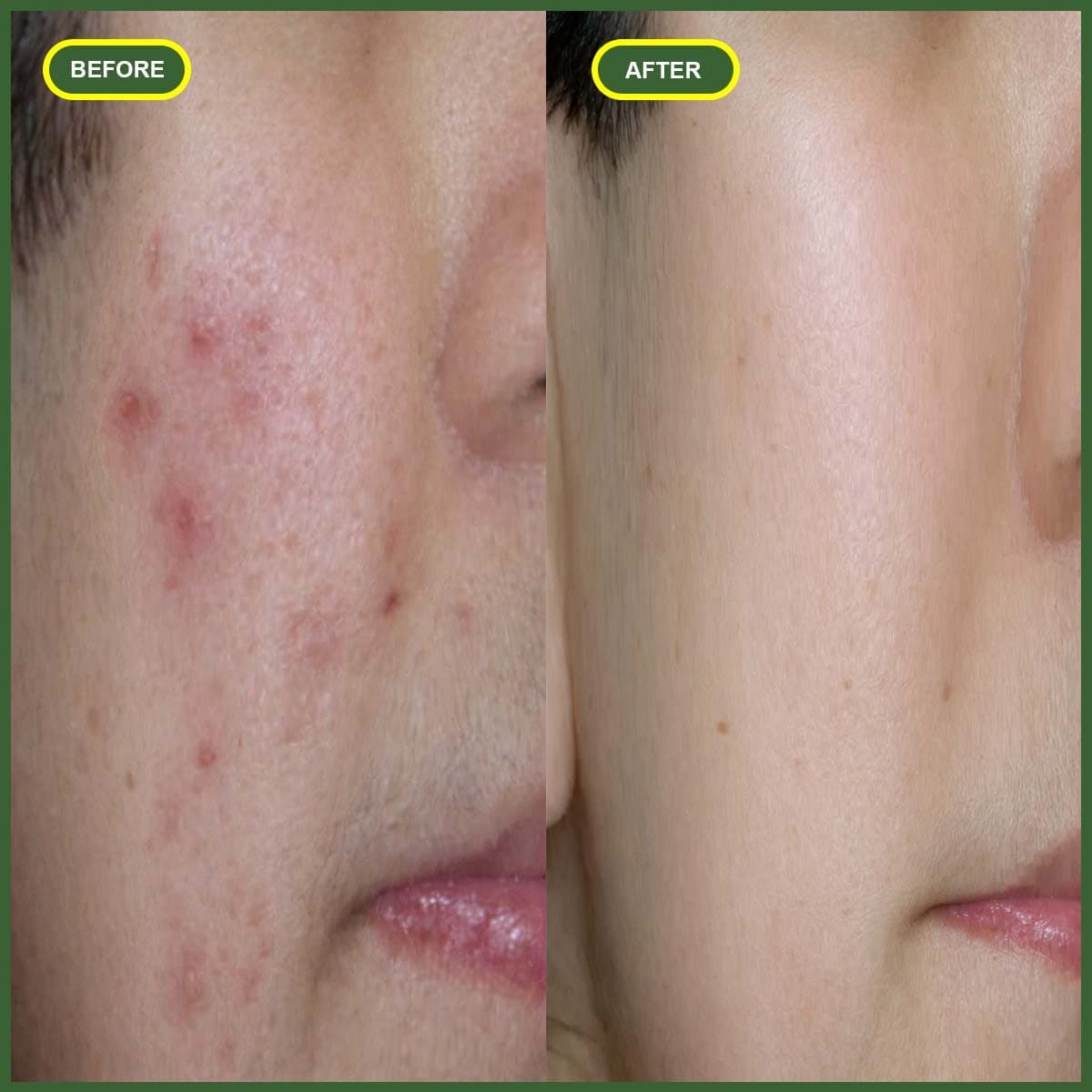ACNEPURA Anti Acne serum