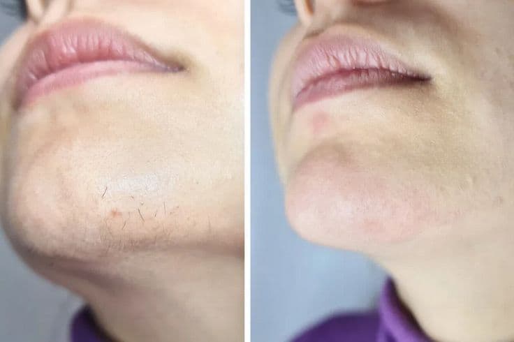 HIRSUTEX PERMANENT HAIR GROWTH INHIBITOR SERUM